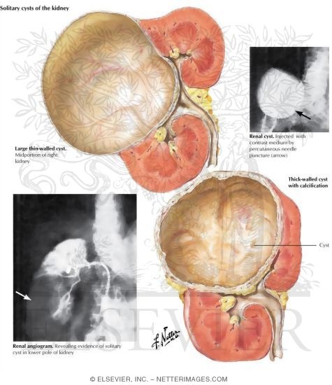 Watermarked preview of labeled image: Solitary Cysts of the Kidney