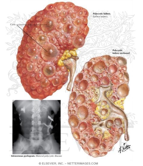 Watermarked preview of labeled image: Renal Cystic Diseases