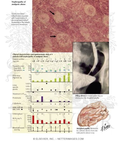 Watermarked preview of labeled image: Nephropathy of Analgesic Abuse