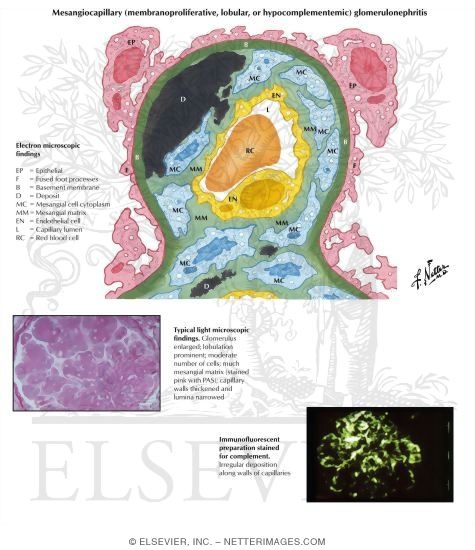 Watermarked preview of labeled image: Chronic Glomerulonephritis