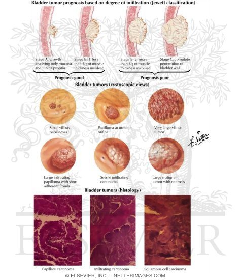 Watermarked preview of labeled image: Tumors of the Bladder