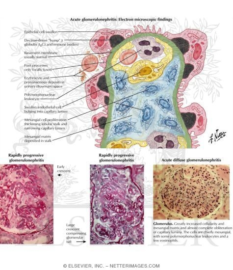 Acute Glomerulonephritis
