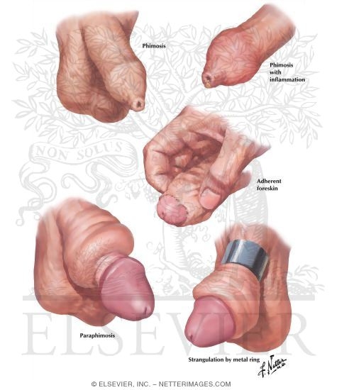 Phimosis, Paraphimosis, Strangulation
