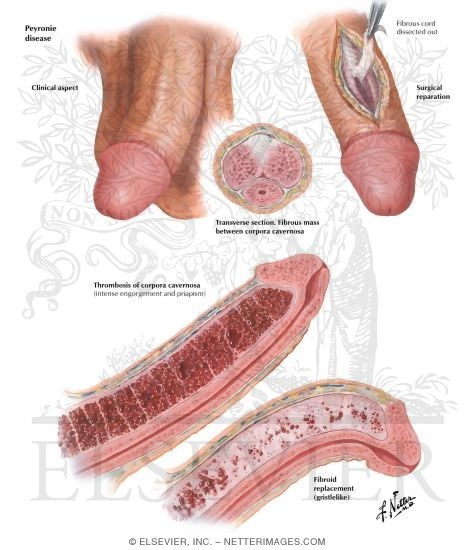 Peyronie's Disease, Priapism, Thrombosis