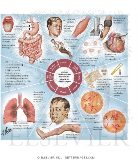 Uremia 
