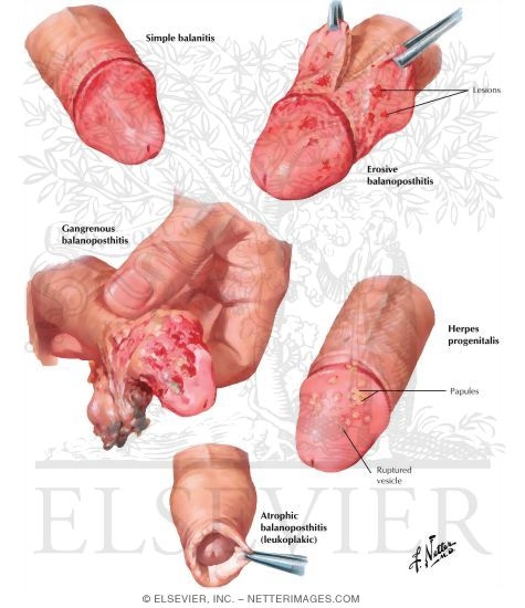 Balanitis