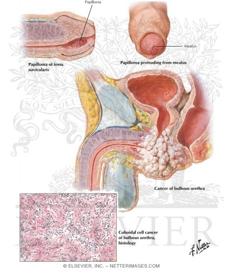 Papilloma, Cancer of Urethra