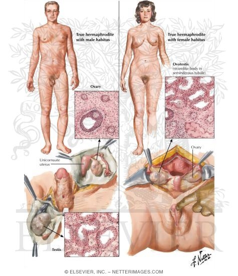 Disorders of Sex Development (Continued)