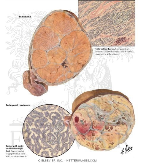 Watermarked preview of labeled image: Testicular Tumors I - Seminoma, Embryonal Carcinoma