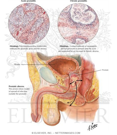 Watermarked preview of labeled image: Prostatitis