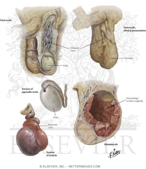 Varicocele, Hematocele, Torsion