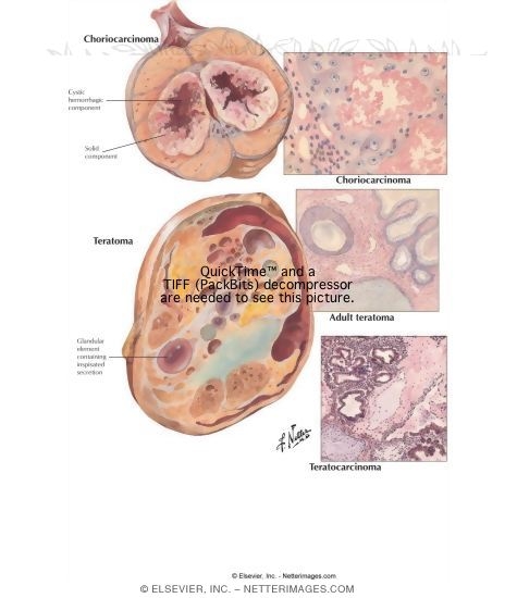 Testicular Tumors II - Chorionepithelioma, Teratoma, Teratocarcinoma