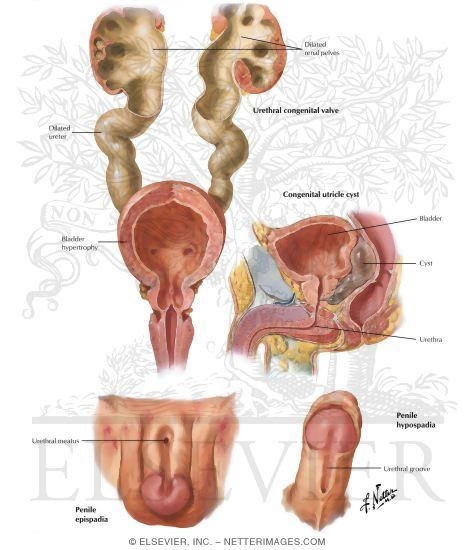 Watermarked preview of labeled image: Congenital Anomalies: Congenital Valves, Epispadia, and Hypospadia