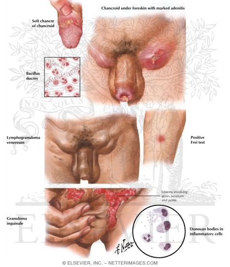 Donovanosis (granuloma inguinal): MedlinePlus enciclopedia ...