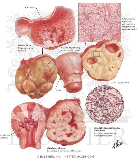 Carcinoma - Primary Cystic Carcinoma, Primary Solid Carcinoma, Secondary Ovarian Carcinoma, Krukenberg Tumor