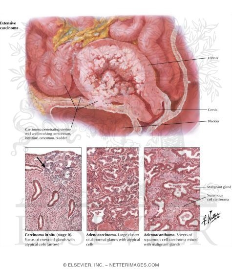 Cancer of Corpus II - Histology and Extension