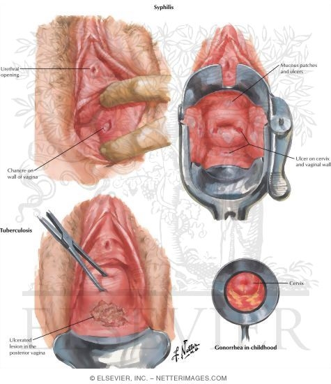Watermarked preview of labeled image: Vaginitis II: Gonorrhea, Syphilis, Tuberculosis