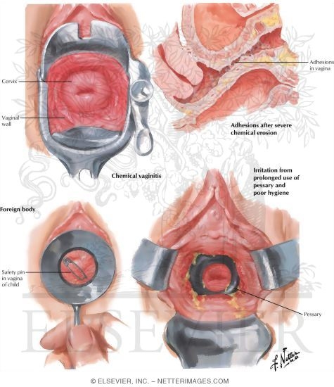 Vaginitis III, Chemical, Traumatic