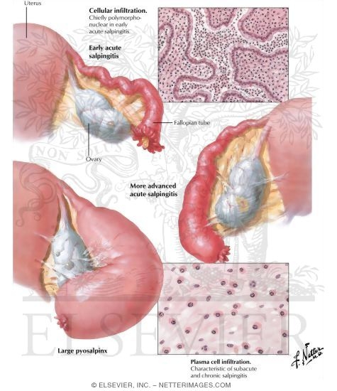 Acute Salpingitis II, Pyosalpinx