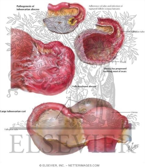 Tubo-ovarian Abscess