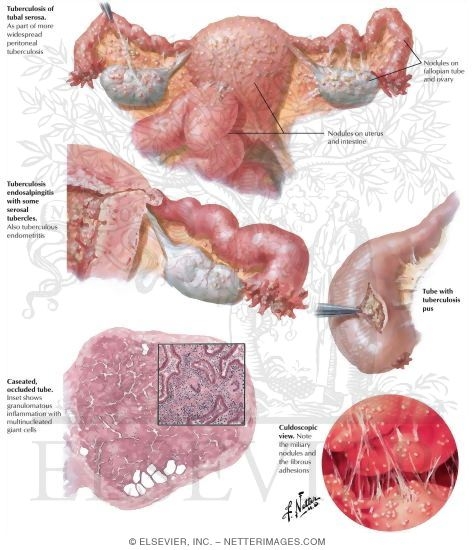 Tuberculosis