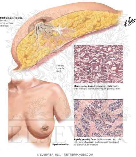 Infiltrating Carcinoma (Scirrhus)