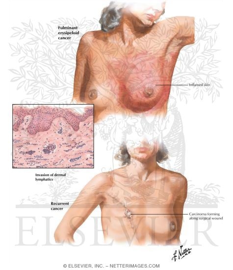 Fulminant Carcinoma
