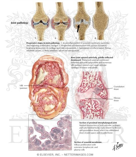Joint Pathology in Rheumatoid Arthritis