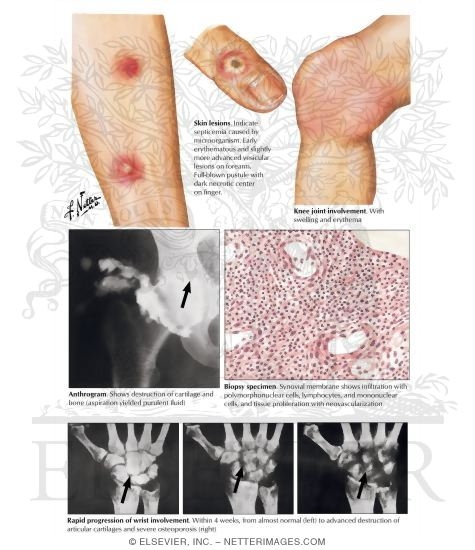 Watermarked preview of labeled image: Infectious Arthritis