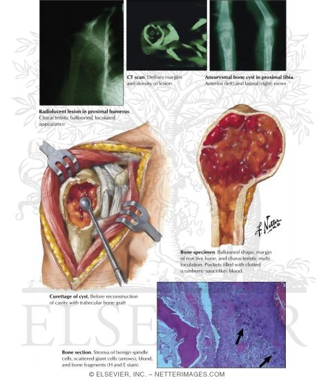 Aneurysmal Bone Cyst