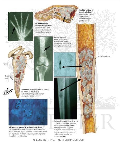Watermarked preview of labeled image: Enchondroma