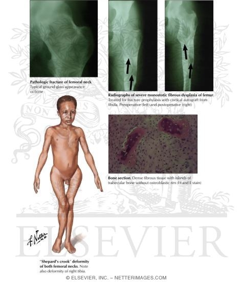 Watermarked preview of labeled image: Fibrous Dysplasia