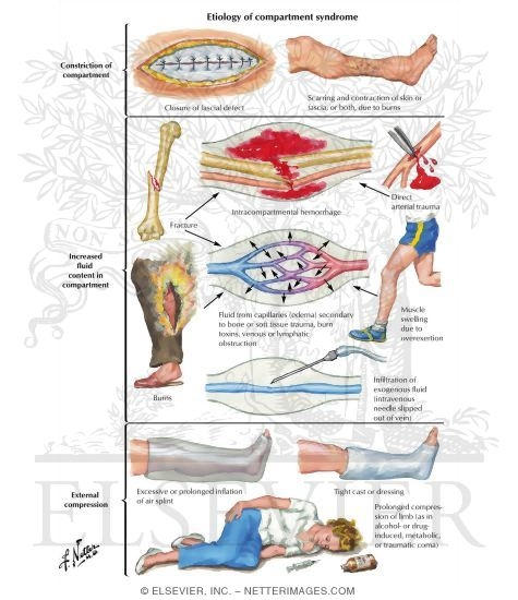 Watermarked preview of labeled image: Etiology of Compartment Syndrome 