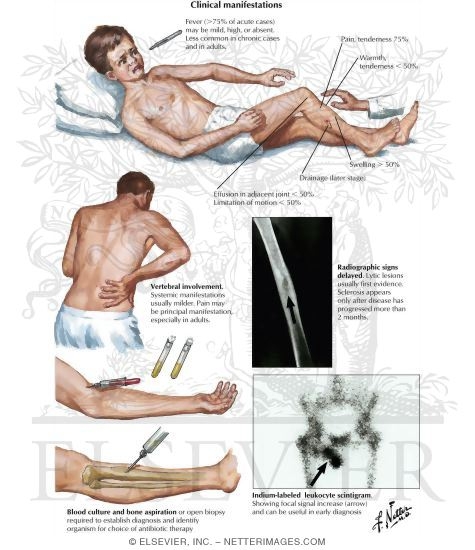 Clinical Manifestations of Hematogenous Osteomyelitis