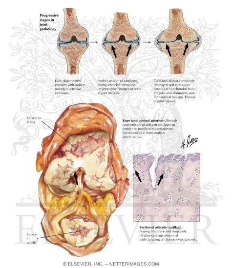 Watermarked preview of labeled image: Joint Pathology In Osteoarthritis