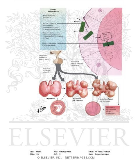 Watermarked preview of labeled image: Etiology of Nontoxic Goiter and Nontoxic Adenoma