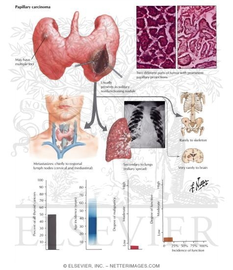 Papillary Carcinoma of the Thyroid