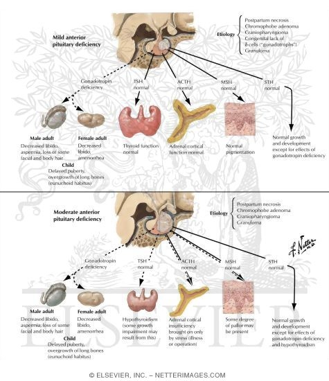 Watermarked preview of labeled image: Selective and Partial Hypopituitarism