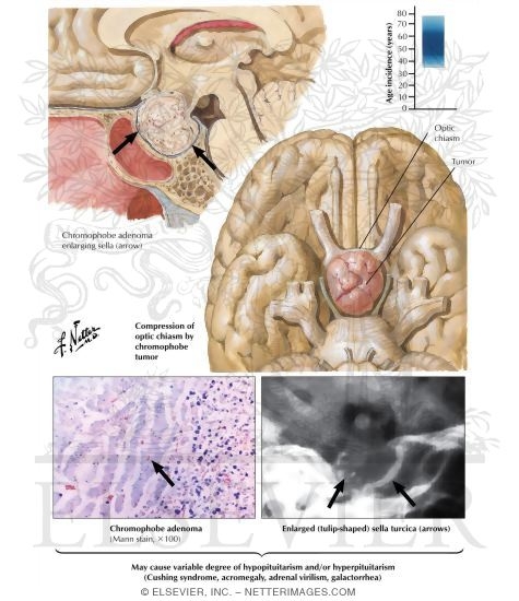 Watermarked preview of labeled image: Clinically Nonfunctioning Pituitary Tumor