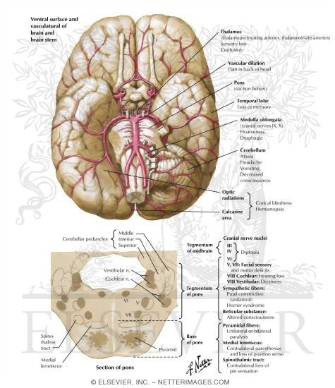 Watermarked preview of labeled image: Ischemia in Vertebrobasilar Territory: Clinical Manifestations Related to Site