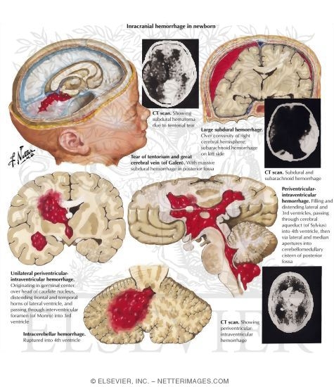 Watermarked preview of labeled image: Intracranial Hemorrhage in Newborn