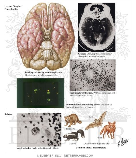 Watermarked preview of labeled image: Herpes Simplex Encephalitis