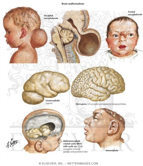 Watermarked preview of labeled image: Brain Malformations
