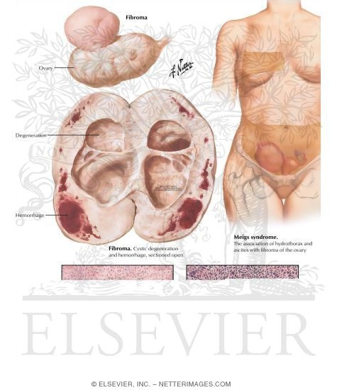 Illustration of Stromatogenous Neoplasms - Fibroma, Meigs' Syndrome, Sarcoma from the Netter Collection
