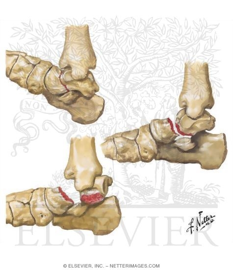 Watermarked preview of unlabeled image: Fracture of Talar Neck