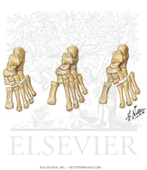 Watermarked preview of unlabeled image: Injury to Tarsometatarsal (Lisfranc) Joint Complex