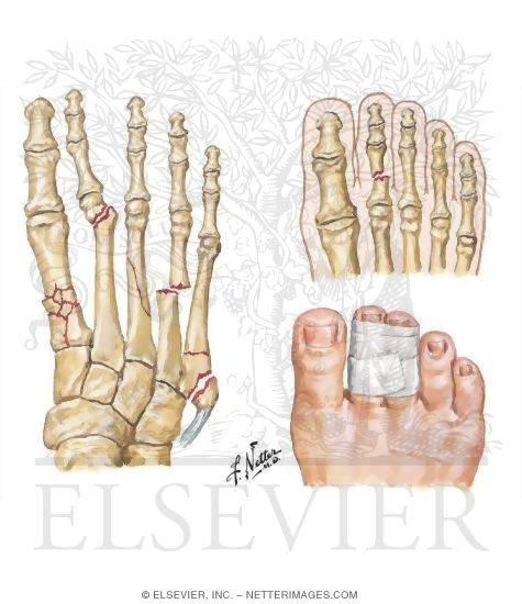 Watermarked preview of unlabeled image: Fractures of the Foot