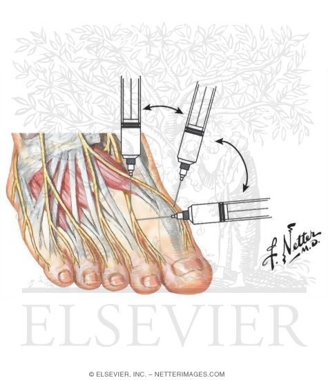 Watermarked preview of unlabeled image: Ankle Arthrocentesis