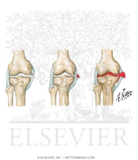 Degrees of Knee Sprain