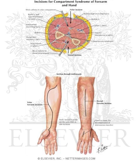 Incisions for Compartment Syndrome of Forearm and Hand
Surgical Approaches